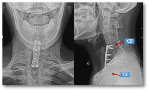 廖博團隊完成世界首例 頸胸段先天性脊柱畸形合并脊髓疝術后翻修 術