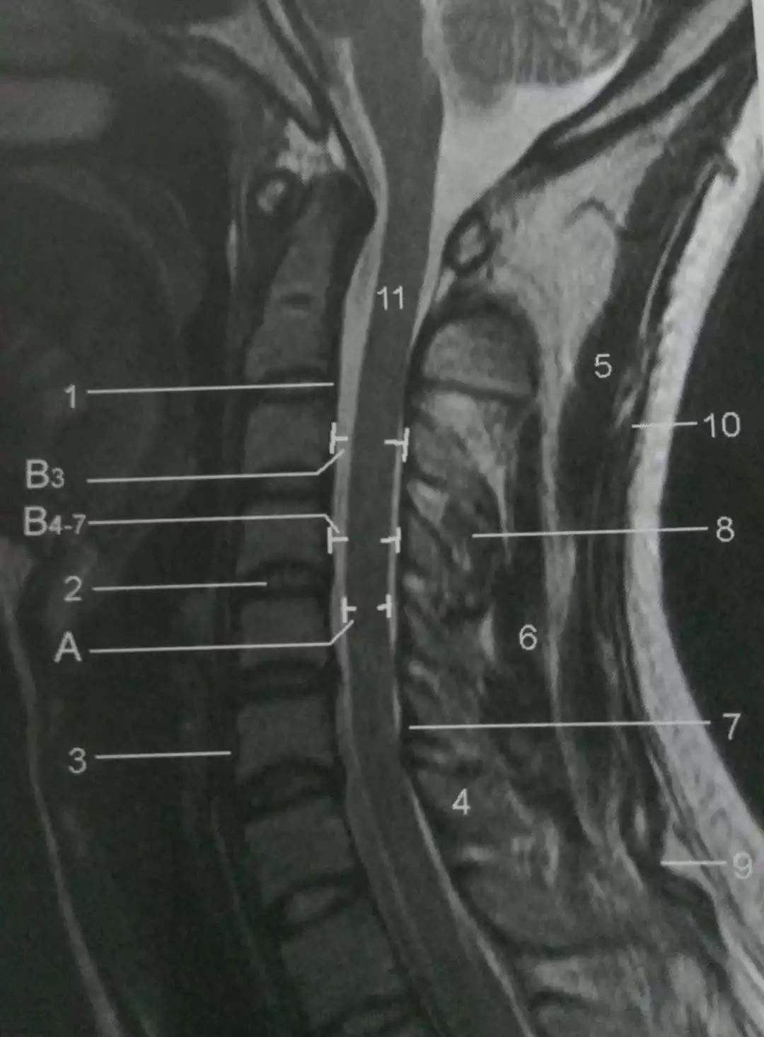 頸胸腰椎mri解剖圖譜【收藏】